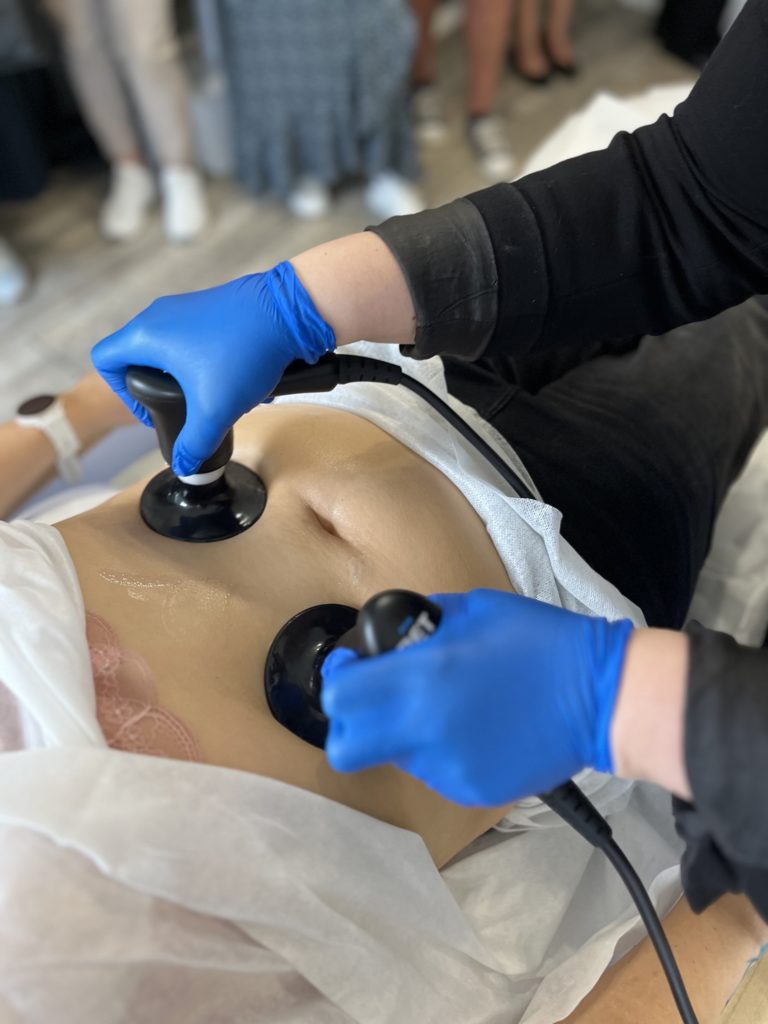 Zbliżenie na zabieg modelowania ciała wykonywany technologią Sirion na brzuchu kobiety